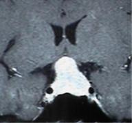 Pre-operative MRI scan of pituitary tumour