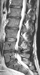 MRI scan showing prolapsed L4/5 disc